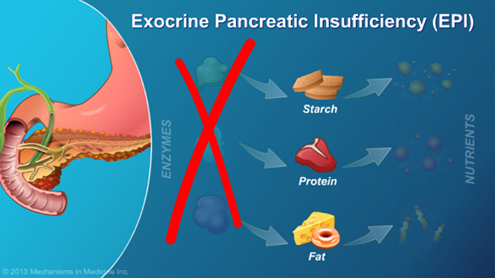 Exocrine Pancreatic Insufficiency Epi 3496