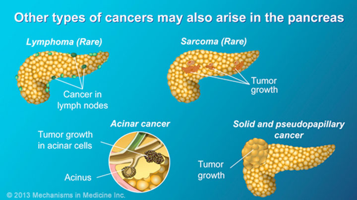 Pancreatic Cancer - Pathophysiology, Diagnosis And Staging