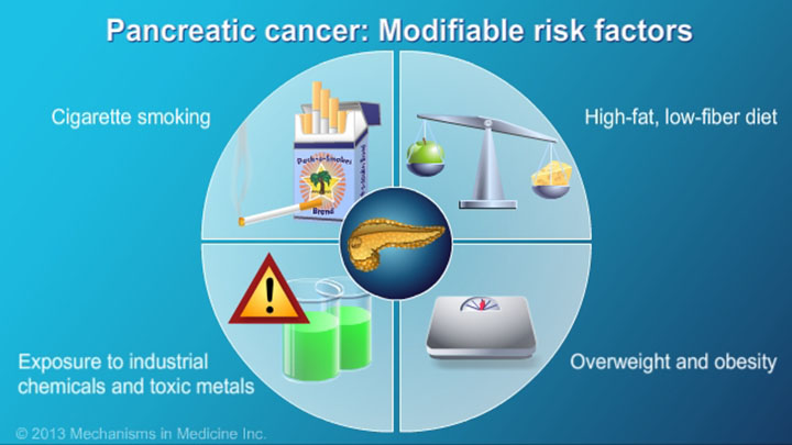 Pancreatic Cancer Signs Symptoms And Risk Factors