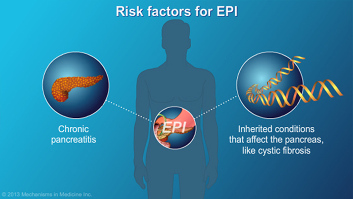 Exocrine Pancreatic Insufficiency (EPI)