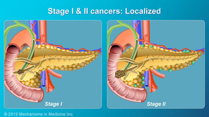 Pancreatic Cancer Pathophysiology Diagnosis And Staging 3486