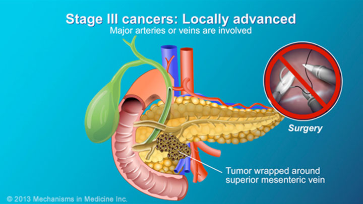 pancreatic-cancer-pathophysiology-diagnosis-and-staging