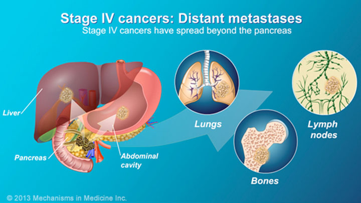 pancreatic-cancer-pathophysiology-diagnosis-and-staging