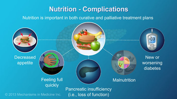 Pancreatic Cancer - Treatment And Outcomes