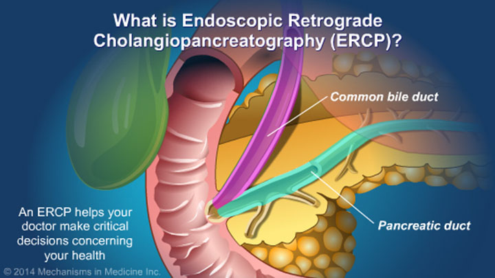 Understanding ERCP