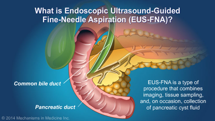 Understanding EUS-FNA