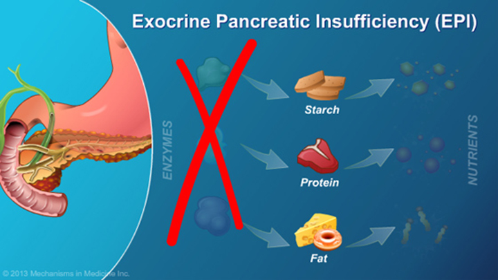 Exocrine Pancreatic Insufficiency (EPI)