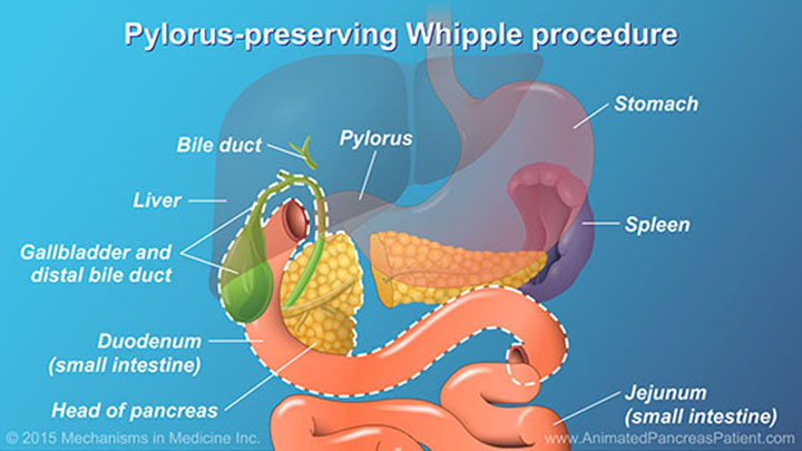 Understanding Pancreatic Surgery Benefits Risks And Relevant Anatomy