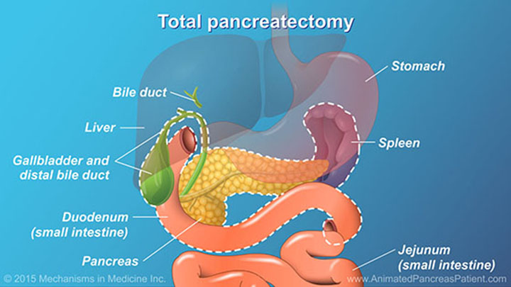 Understanding Pancreatic Surgery: Benefits, Risks, and Relevant Anatomy