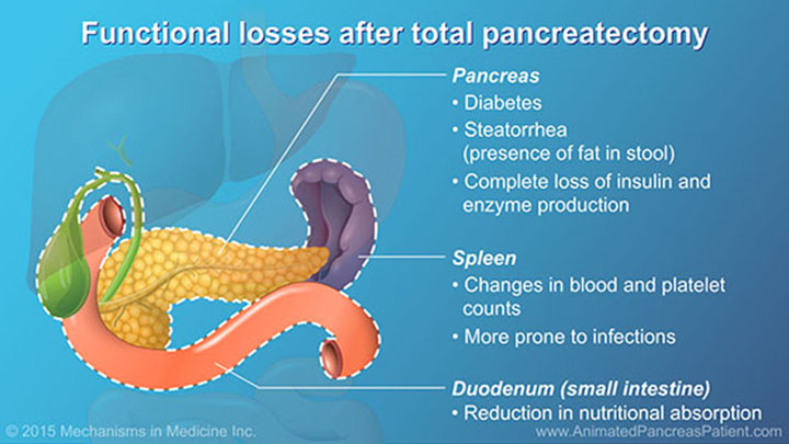 Understanding Pancreatic Surgery Benefits Risks And Relevant Anatomy