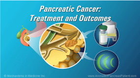 Pancreatic Cancer - Treatment And Outcomes