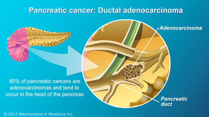 Pancreatic Cancer - Pathophysiology, Diagnosis and Staging