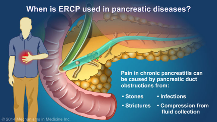 chronic pancreatitis ercp