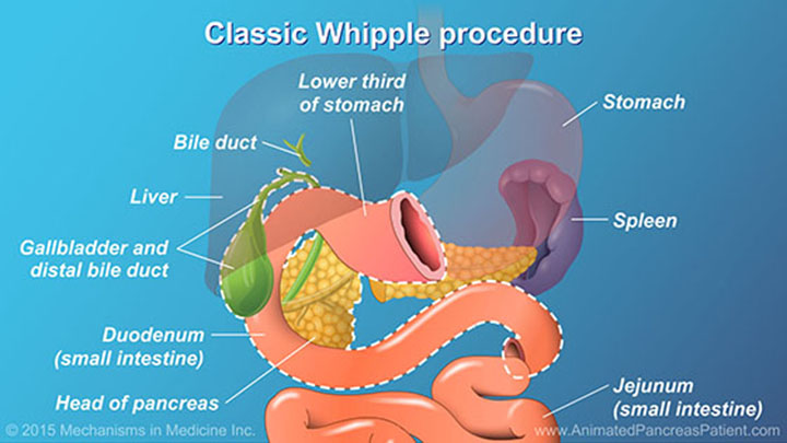 whipple procedure animation
