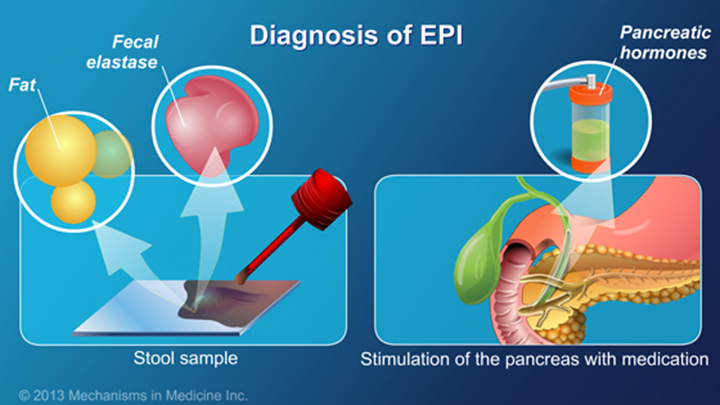 Slide Show - Exocrine Pancreatic Insufficiency (EPI)
