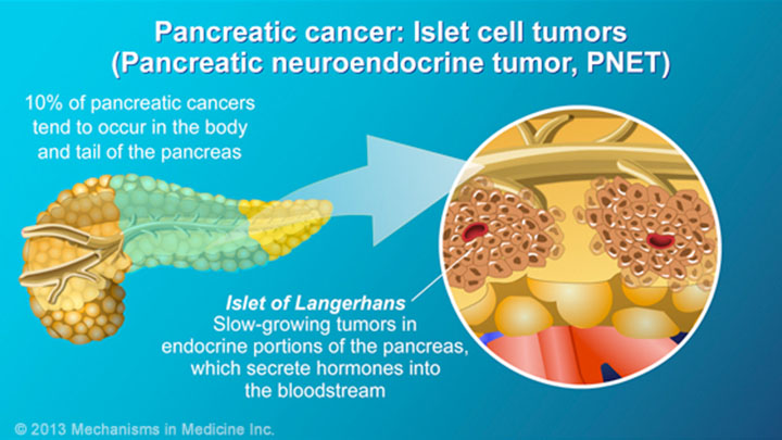 Pancreatic Cancer - Pathophysiology, Diagnosis and Staging