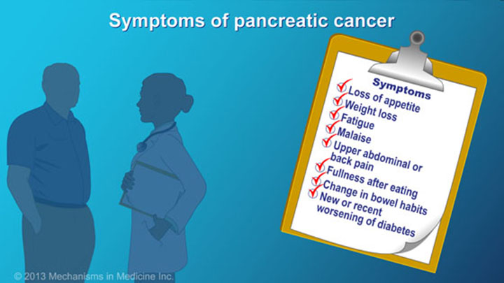 Pancreatic Cancer - Signs, Symptoms and Risk Factors