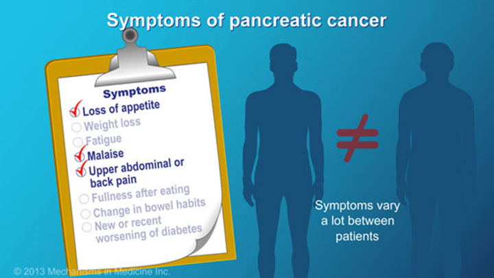 Pancreatic Cancer - Signs, Symptoms and Risk Factors