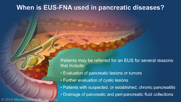 Understanding EUS-FNA