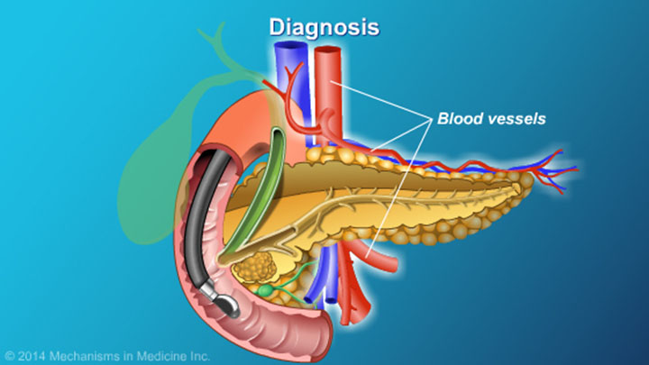 Understanding EUS-FNA