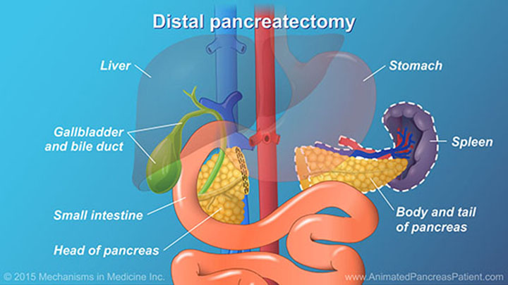 Understanding Pancreatic Surgery: Benefits, Risks, and Relevant Anatomy