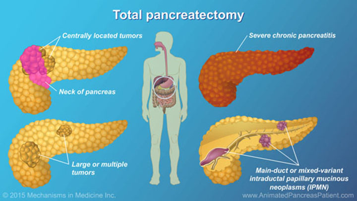 Understanding Pancreatic Surgery: Benefits, Risks, and Relevant Anatomy