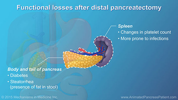 Understanding Pancreatic Surgery: Benefits, Risks, and Relevant Anatomy